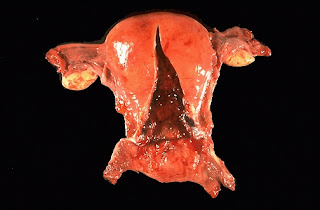 Uterus.jpg